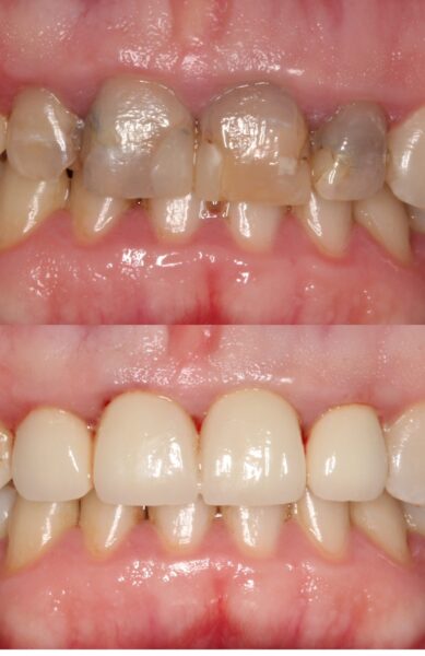 Poprawa estetyki uśmiechu za pomocą koron i licówek porcelanowych